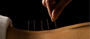 Akupunktur i ryggen