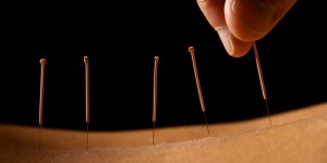 Akupunktur behandlilng