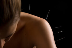 Akupunktur behandling i skulder