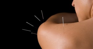 Akupunktur i skulder