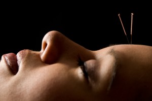 Akupunktur i pande