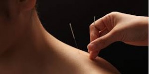 Akupunktur behandling